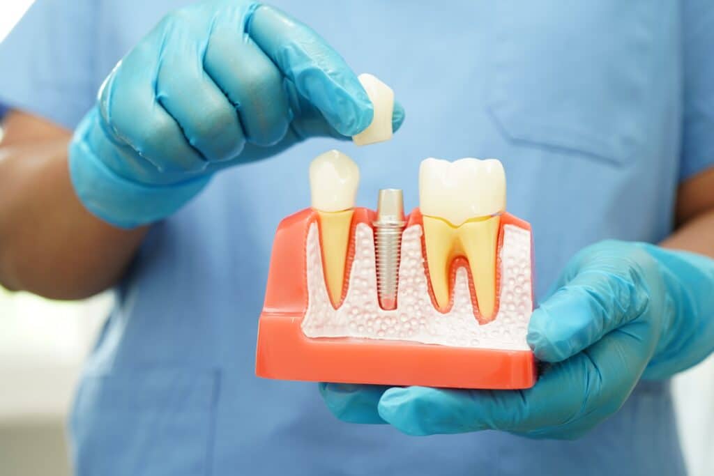 dental implants Oklahoma city