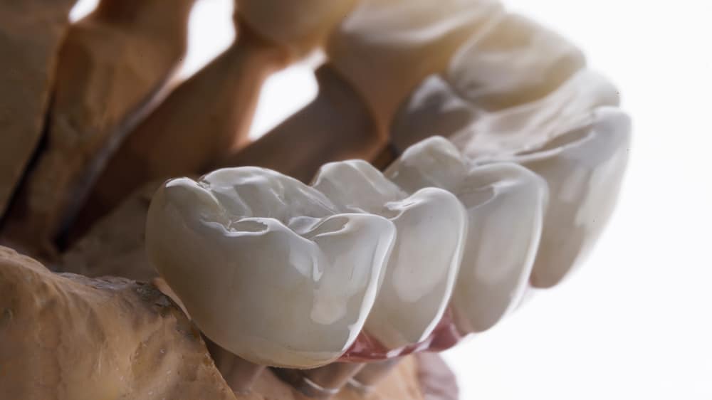 dental bridges Oklahoma city